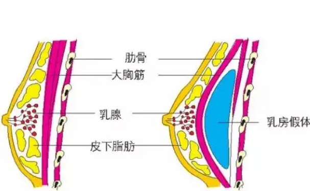 包头市第七医院美容科硅胶隆胸多少钱?术后三个月案例曝光