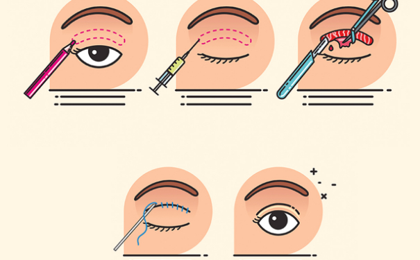 常州102医院全切双眼皮价格表?技术优点怎么样?